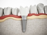 Можно ли обойтись без КТ при имплантации зуба?